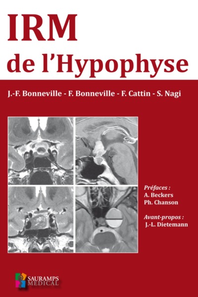 IRM de l'hypophyse