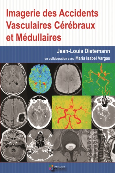 Imagerie des accidents vasculaires cérébraux et médullaires - Jean-Louis Dietemann