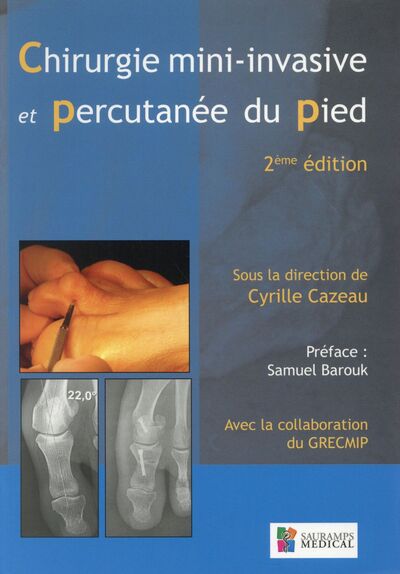 Chirurgie mini-invasive et percutanée du pied - Cyrille Cazeau